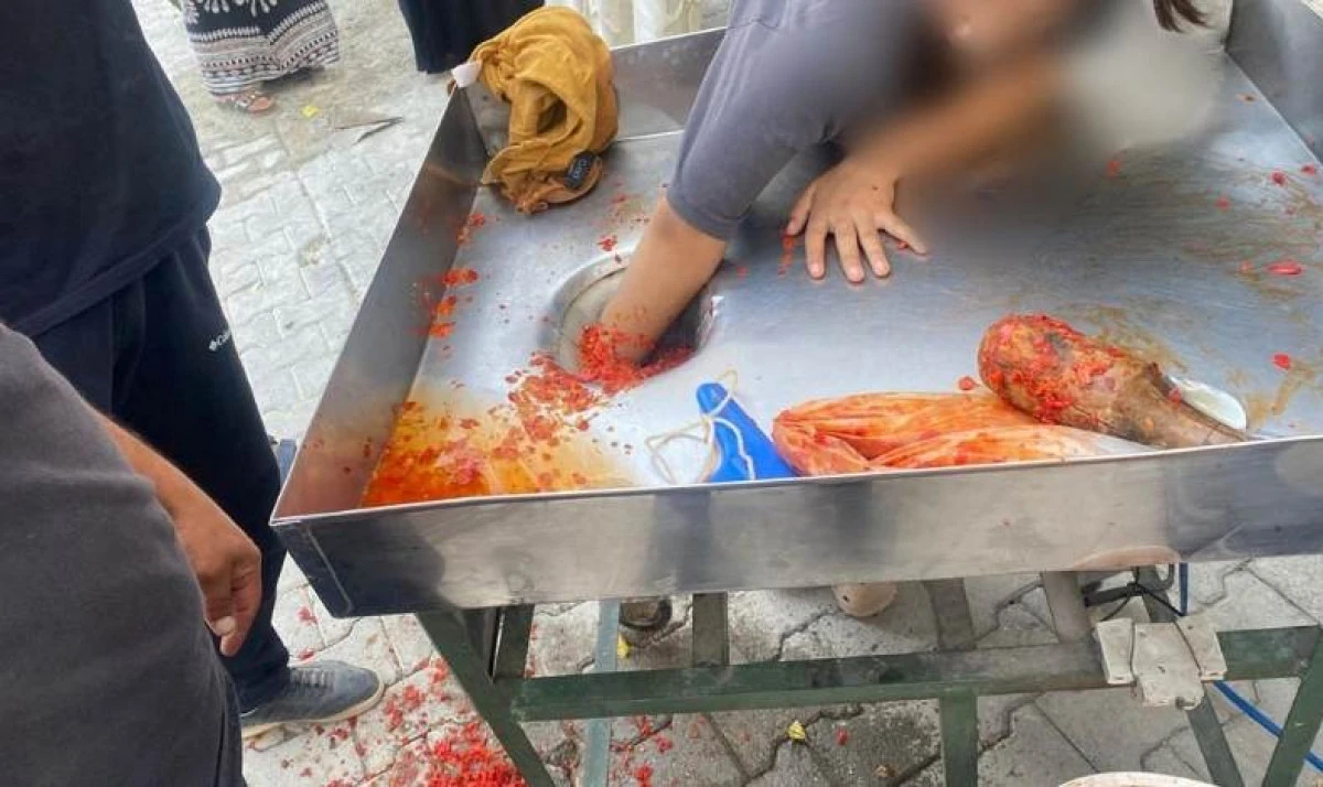 16 Yaşındaki Ayşenur Uzuv Kaybından Kurtuldu